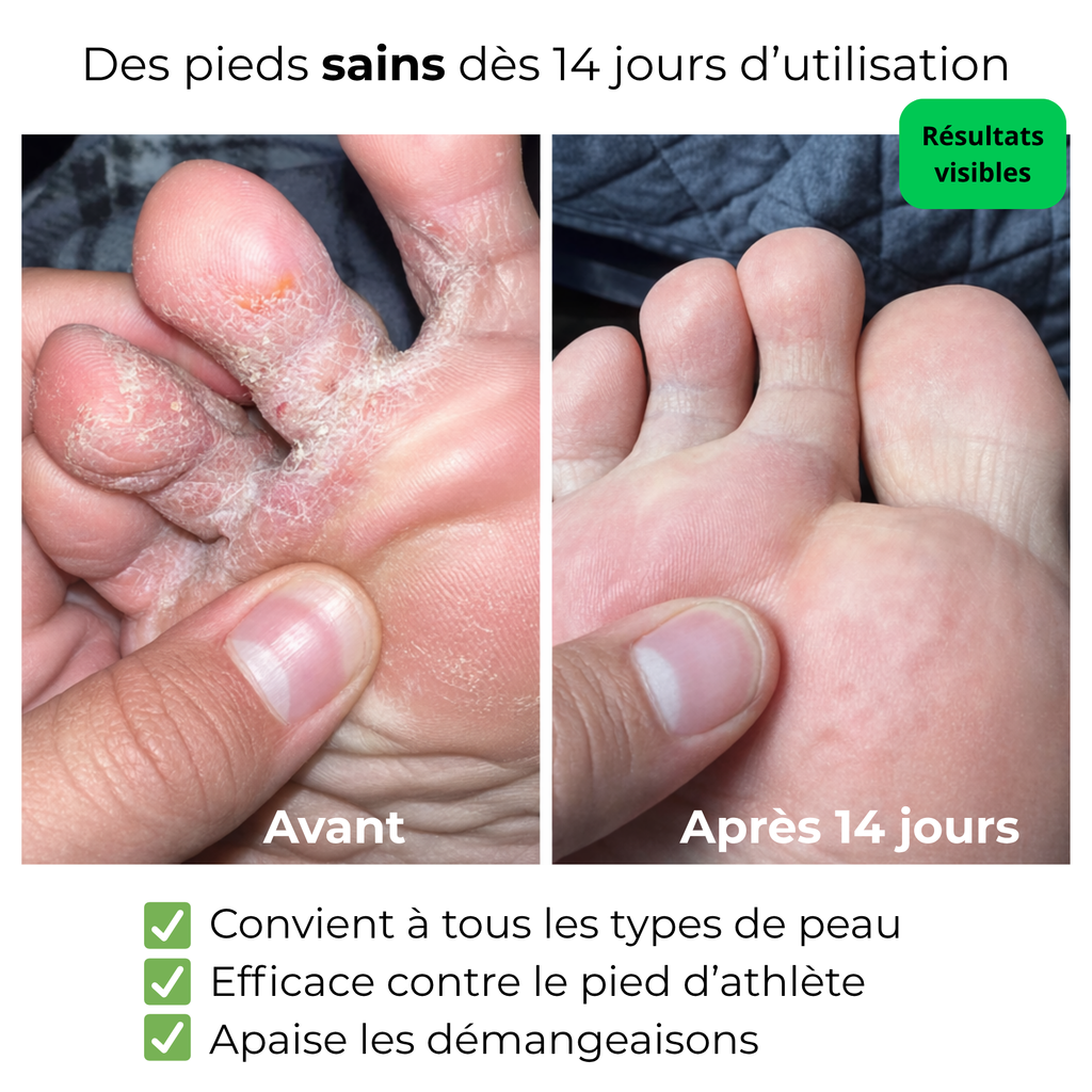 Anerys - Savon antifongique contre le pied d'athlète