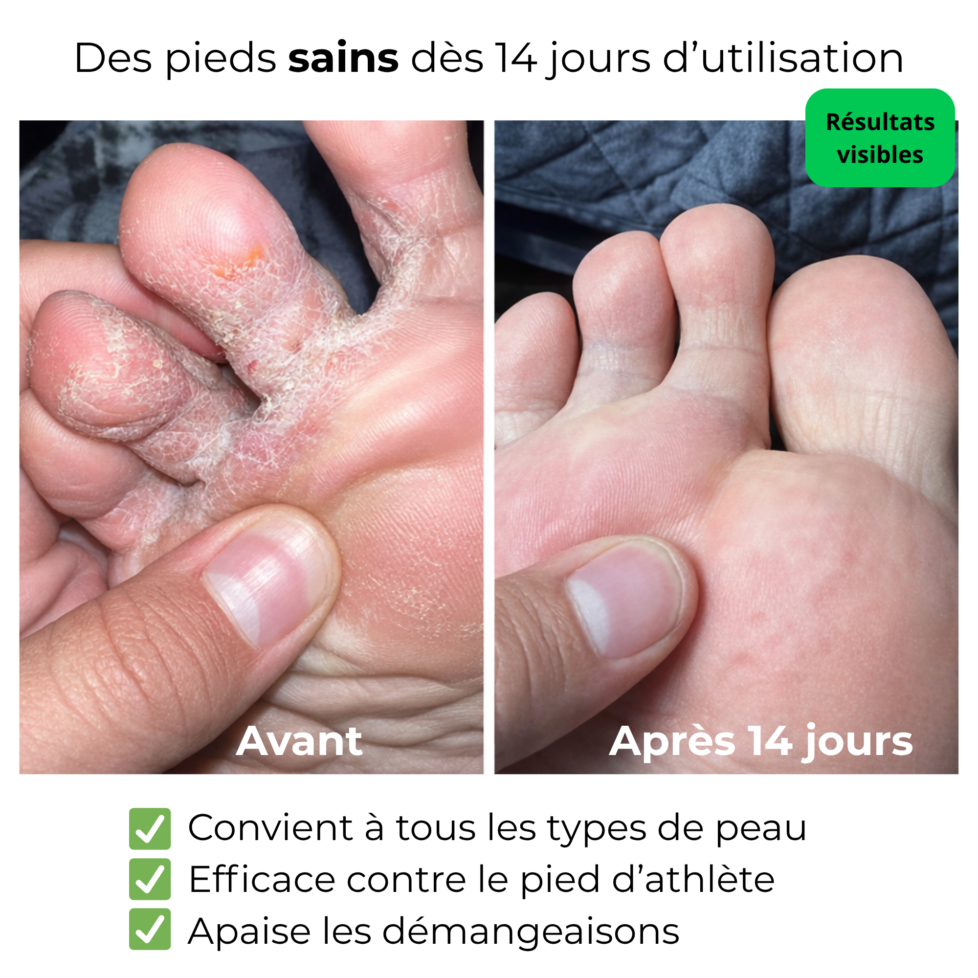 Anerys - Savon antifongique contre le pied d'athlète